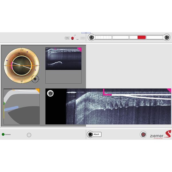 A imagem OCT permite o mapeamento automatizado da superfície ocular e detecções de bordas, além de fornecer visualização ao vivo em todos os estágios do procedimento refrativo, catarata ou terapêutico.