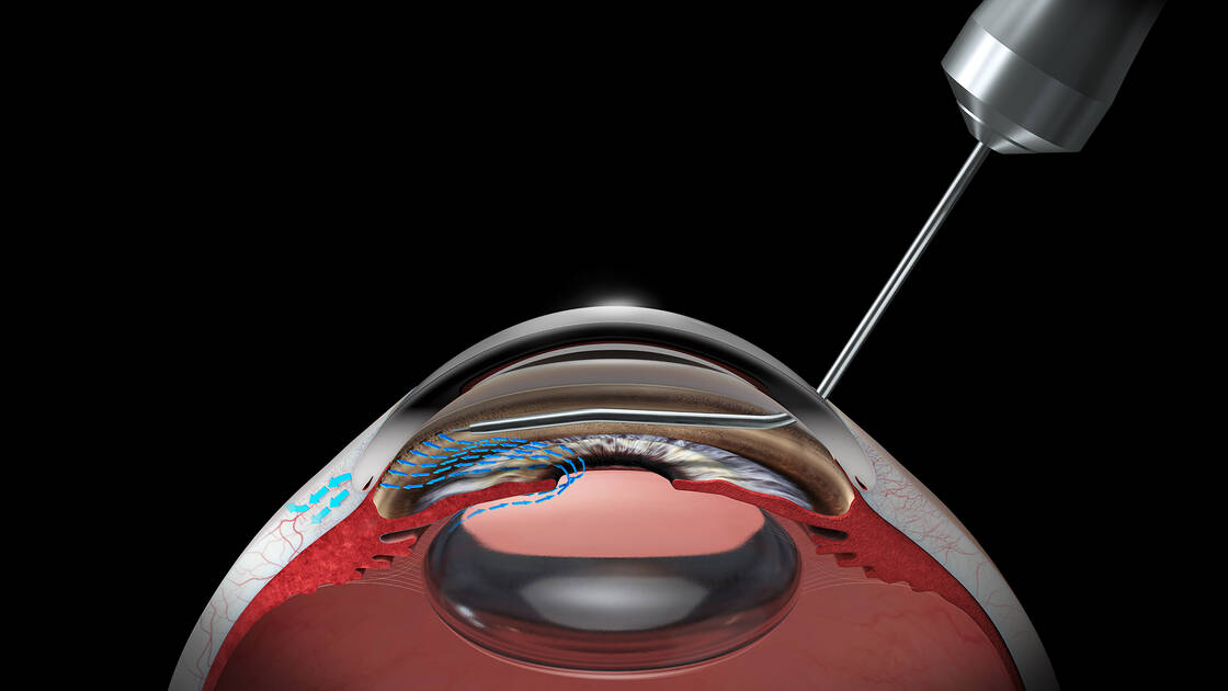 Animação demonstra a utilização do HFDS durante cirurgia oftalmológica com o Faros.
