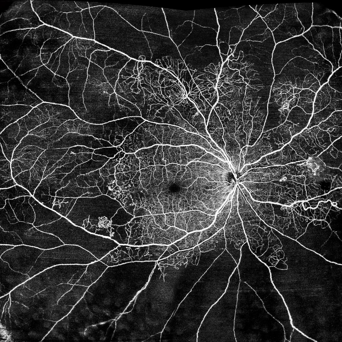 Retina e Vítreo