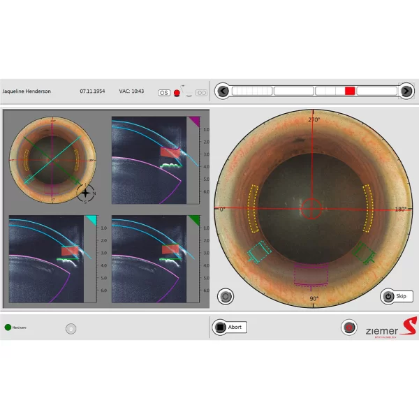 Incisões Clear Cornea (CCI) - Determine individualmente o tamanho, geometria e posição desejada de cada incisão com base na LIO selecionada