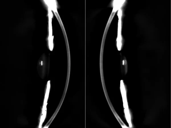 Tomografia de Sistema Duplo Scheimpflug -
        Paquimetria e dados de elevação precisos da superfície anterior e posterior ajudam a detectar protuberâncias e assimetria nos estágios iniciais. O equipamento GALILEI está equipado com duas câmeras Scheimpflug, o que reduz significativamente o tempo de exame do segmento anterior