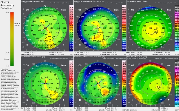 O Display de detecção de assimetria CLMI.X mostra de forma simples e automatizada se o algoritmo detectou um padrão suspeito de assimetrias na córnea.