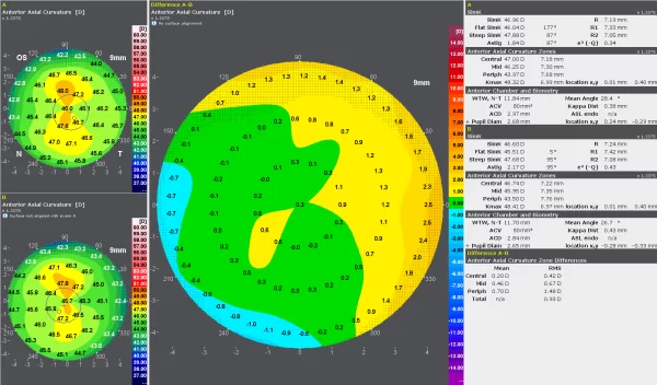 O Display de Comparação oferece um mapa diferencial para permitir a comparação de dois exames realizadas em momentos diferentes e destacando as alterações na córnea.