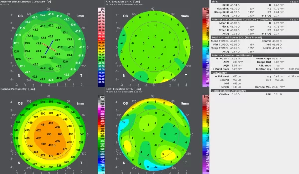 Avaliação visual rápida de assimetrias com dados de elevação anterior e posterior que podem ser facilmente aplicados em relação à espessura da córnea.