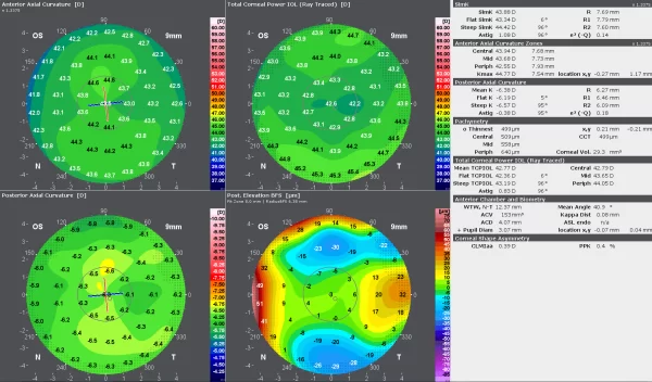 O display de avaliação Refrativa Rápida do GALILEI oferece uma visão geral da córnea para iniciar a análise do olho para o planejamento de cirurgias refrativas.