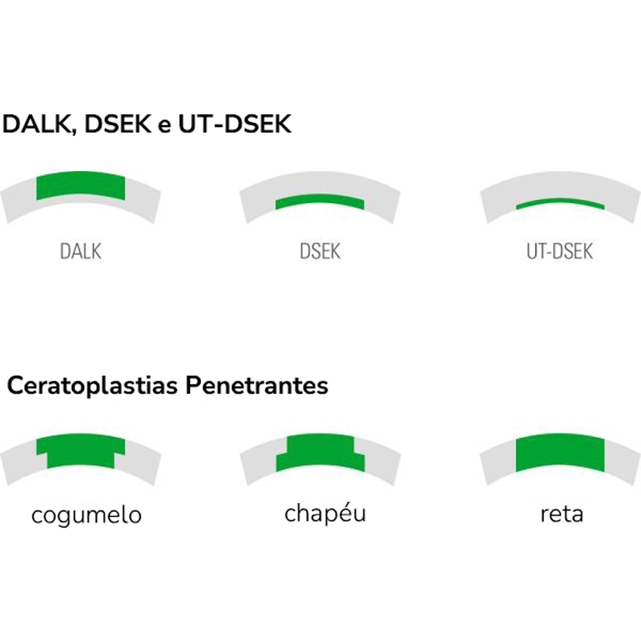 Opções disponíveis entre diferentes ceratoplastias lamelares ultrafinas (DALK, DSEK, UT-DSEK) e ceratoplastias penetrantes (em forma de cogumelo, chapéu e reta)