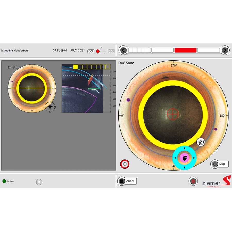 A nova aplicação em ceratoplastia penetrante com interface líquida do FEMTO Z8 preserva a curvatura natural da córnea durante o processo de trepanação a laser