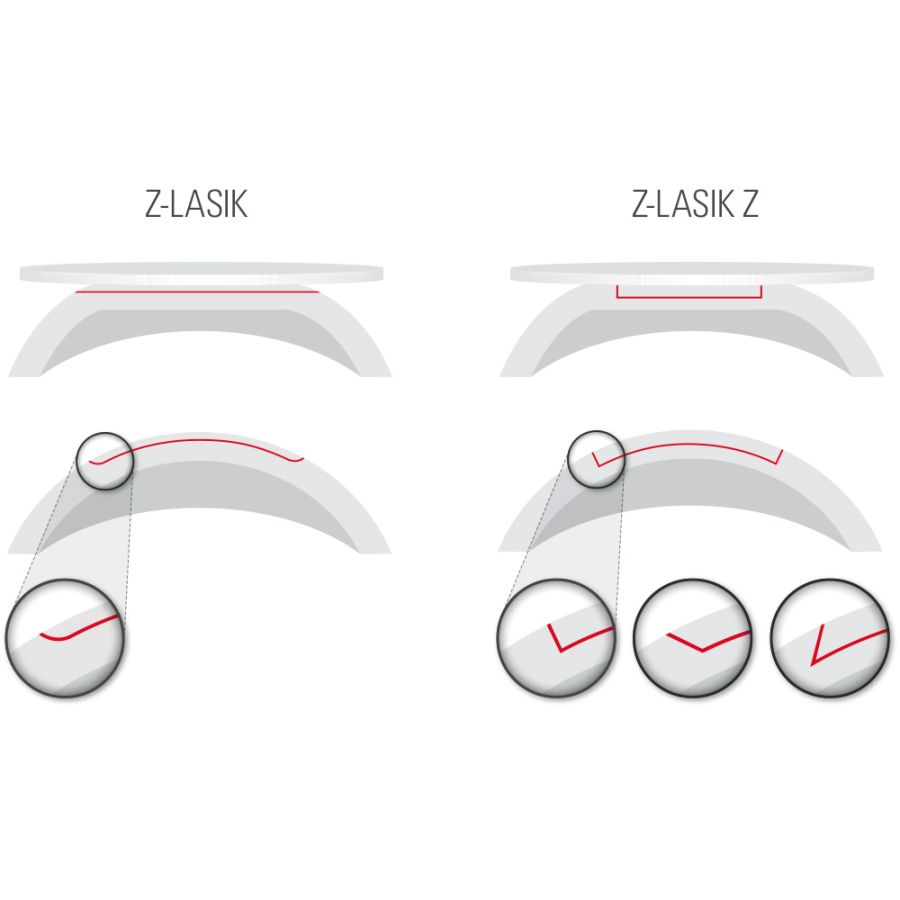 Dois padrões de corte de LASIK a escolher: Padrão Z-LASIK para um corte planar bidimensional grande  Padrão Z-LASIK Z para corte lateral, o que permite recentralizar o flap durante o docking.