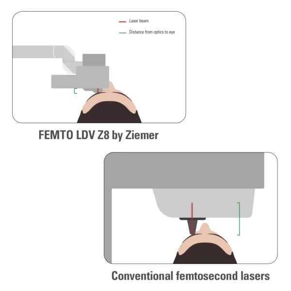 Graças à peça de mão da Ziemer, a distância de trabalho até o olho é muito curta. Portanto, pode-se alcançar um poder de foco alto, necessitando de pouquíssima energia por pulso. Isto permite a produção de pequenos pontos sobrepostos, resultando em um corte uniforme.